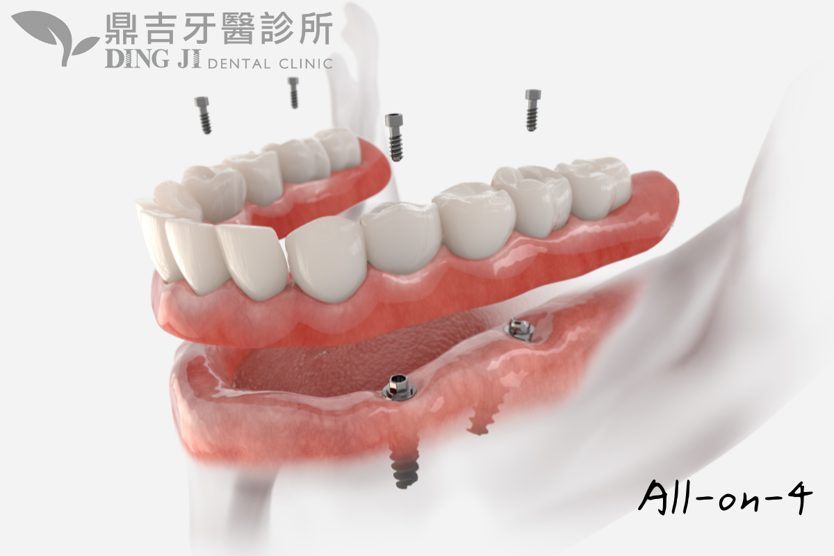 Allon4全口重建